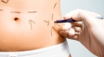 Plastic surgeon marking abdomen Plastic surgeon marking abdomen